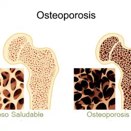OSTEOPOROSIS Podcast artwork